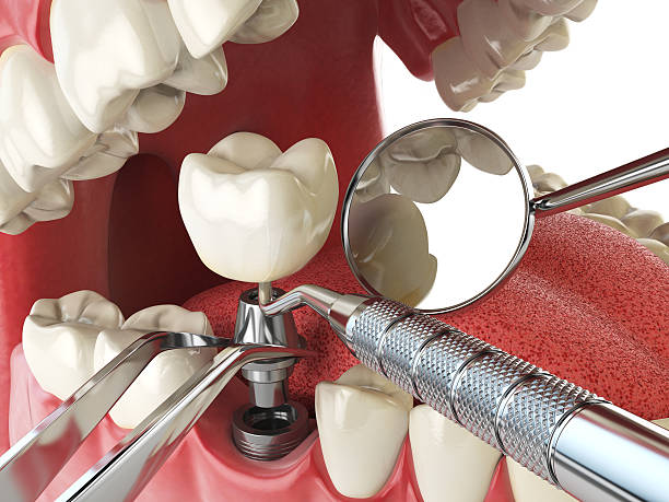 Best Emergency Treatment for Dental Infections or Abscesses in Kiel, WI